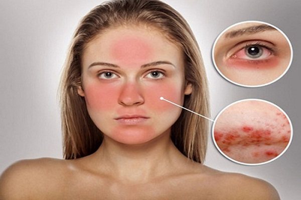 Để không bị dị ứng bởi mỹ phẩm rởm, bạn cần làm gì?